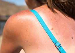 La nuova molecola che potrebbe cambiare la cura del melanoma prima dell’intervento